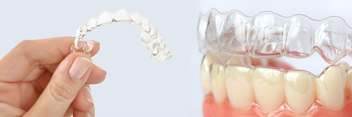 Highlands Ranch Alternative to Braces for Teens