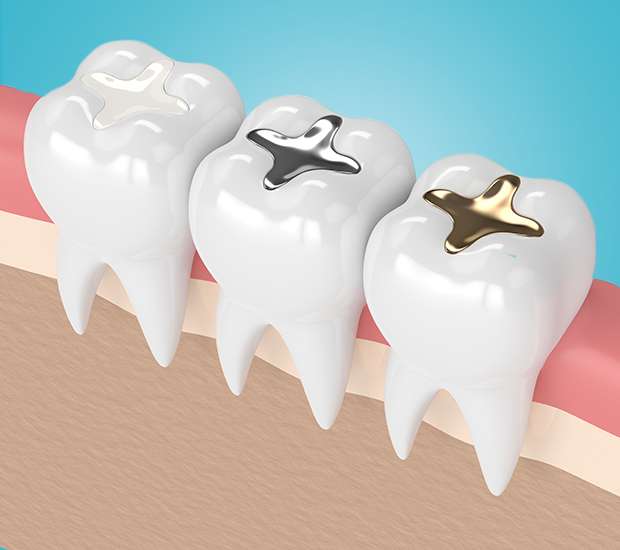 Highlands Ranch Tooth Colored Fillings