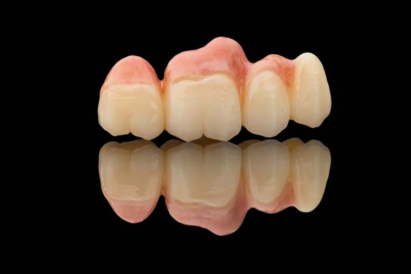 When Is A Dental Bridge Commonly Used?