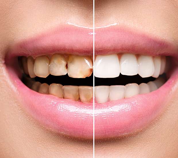 Highlands Ranch Dental Implant Restoration
