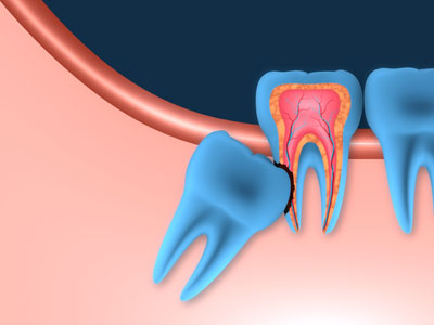 types of impacted wisdom teeth