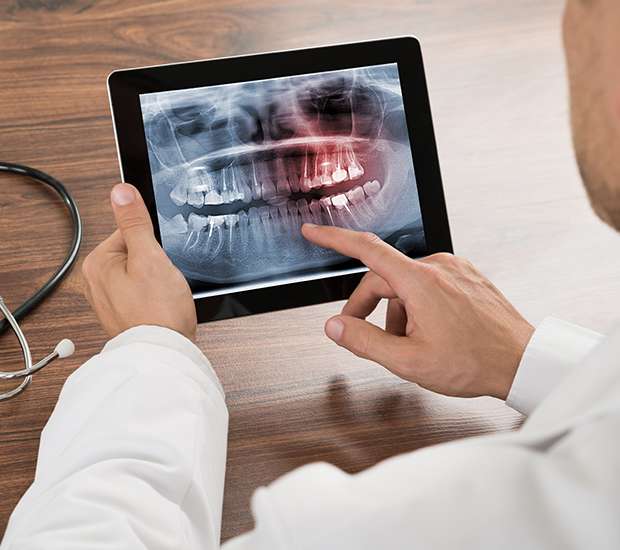 Highlands Ranch Types of Dental Root Fractures