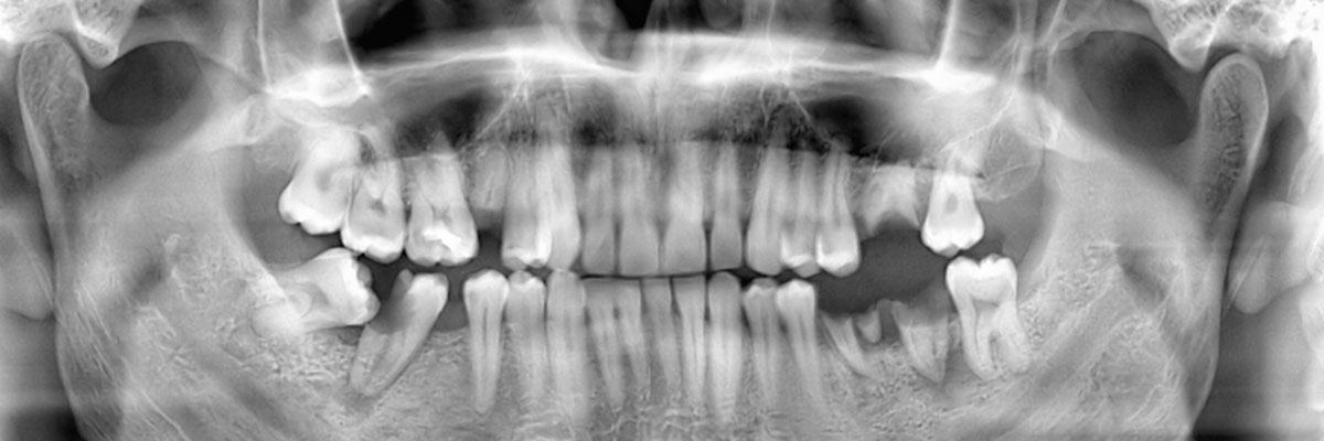 Highlands Ranch Wisdom Teeth Extraction